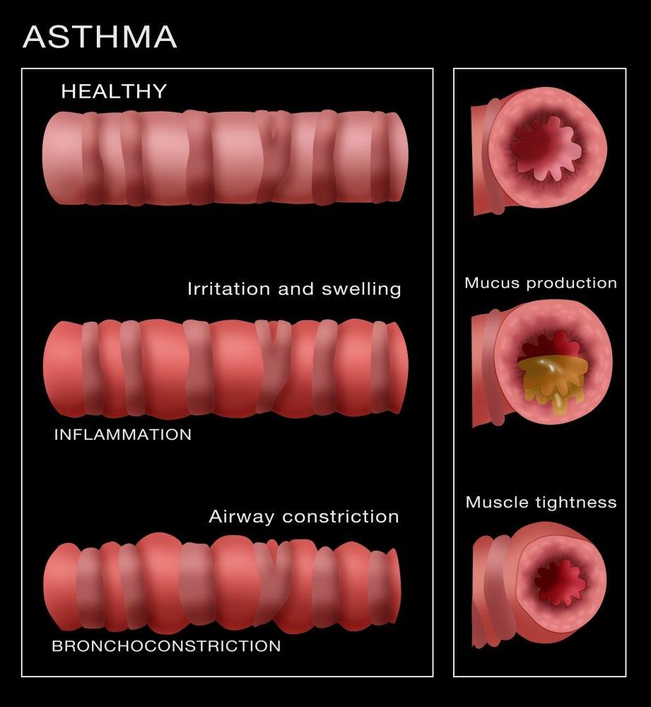 Posterazzi Bronchoconstriction Asthma Poster Print by Monica SchroederScience Source (24 x 36)